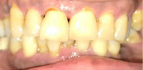 Before and After surgery for upper teeth Photo