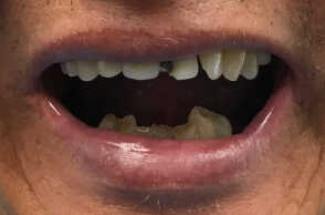 Implants for Dentures Photo