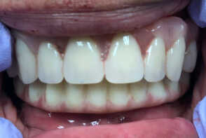 Implants for Dentures Photo