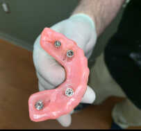 Implants Supported Prothesis Photo