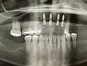 Multiple Implant Photo