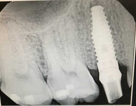 Single Implant Photo